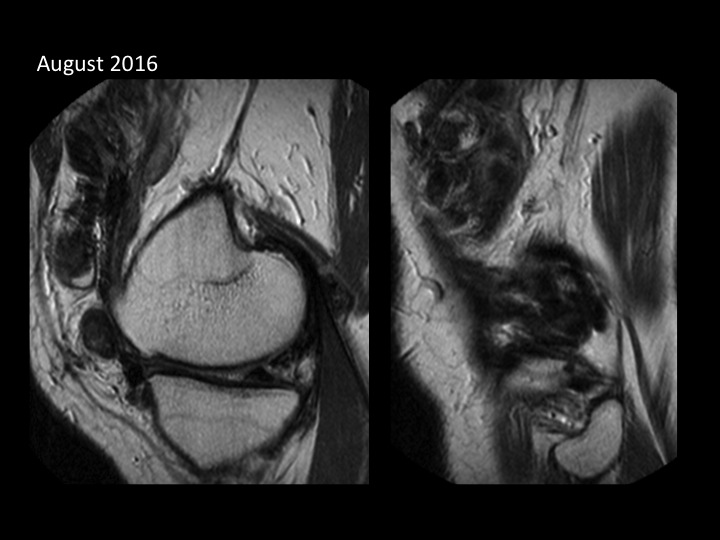 Figure 4 for case pigmented villonodular synovitis ( RID3641 )